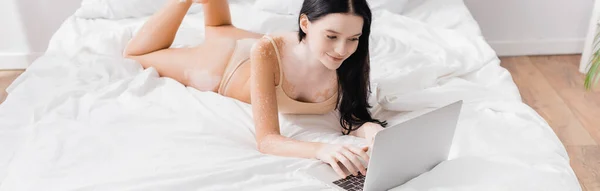 Happy woman with vitiligo lying on bed and using laptop, banner — Stock Photo
