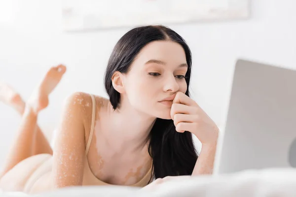 Brünette Frau mit Vitiligo auf dem Bett liegend und auf Laptop schauend — Stockfoto