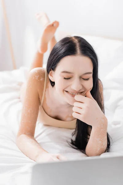 Brunette woman with vitiligo lying on bed and laughing near laptop — Stock Photo