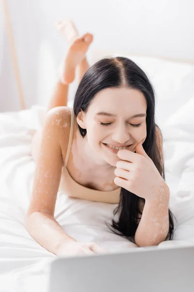 Femme brune avec vitiligo couché sur le lit et riant près d'un ordinateur portable — Photo de stock