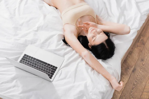 Vue du haut de la jeune femme brune avec vitiligo couché sur le lit près d'un ordinateur portable — Photo de stock