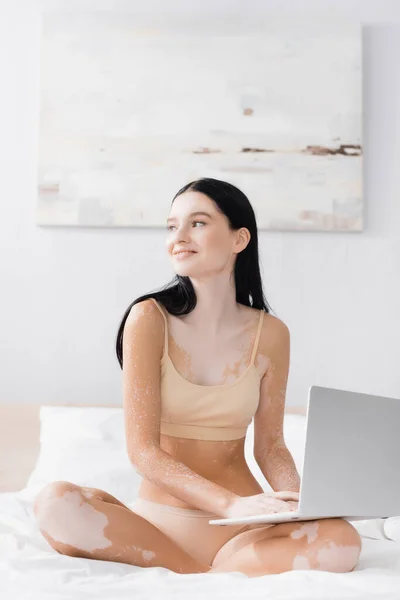 Smiling woman with vitiligo sitting on bed with laptop — Stock Photo