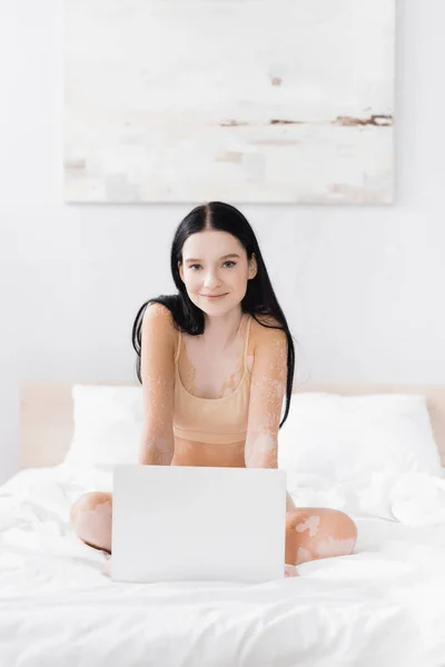 Femme brune avec vitiligo regardant la caméra près de l'ordinateur portable sur le lit — Photo de stock