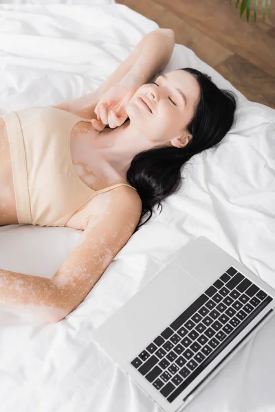 High angle view of brunette woman with vitiligo resting on bed near laptop — Stock Photo