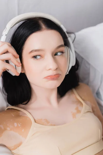 Sad young woman with vitiligo adjusting wireless headphones — Stock Photo