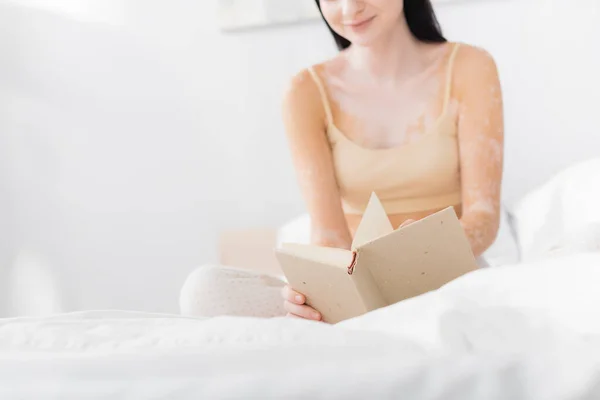 Обрізаний вид жінки з вітіліго тримає книгу і сидить у спальні — стокове фото