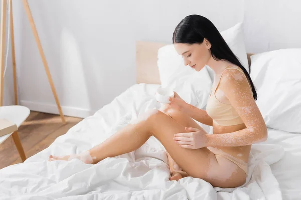 Jeune femme avec vitiligo assis sur le lit et tenant récipient avec de la crème — Photo de stock