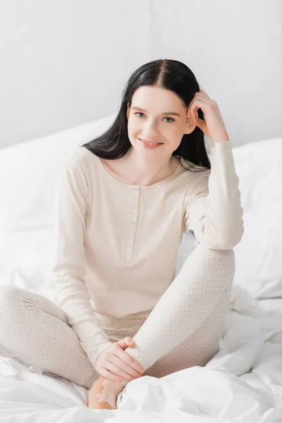 Cheerful young woman with vitiligo sitting on bed and looking at camera — Stock Photo