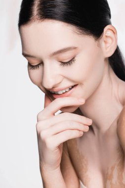 Gülümseyen genç ve güzel kadın vitiligo ile beyaz üzerine izole