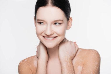 Gülümseyen genç ve güzel kadın vitiligo ile beyaz üzerine izole