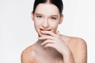 Vitiligo 'su olan genç ve güzel bir kadın beyazda izole edilmiş.