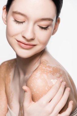 Vitiligo 'su olan genç ve güzel bir kadın beyaz omuzlarına kozmetik krem sürüyor.