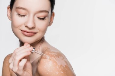 young beautiful woman with vitiligo applying serum on shoulder isolated on white clipart