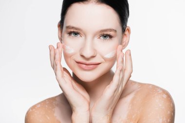Yüzünde vitiligo ve yüz kremi olan gülümseyen genç bir kadın.