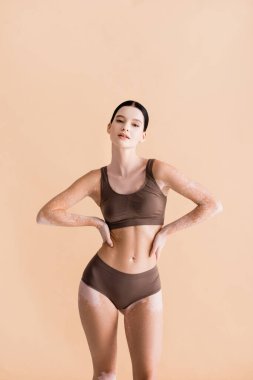 Vitiligo 'lu genç ve güzel bir kadın bej rengi iç çamaşırlarıyla poz veriyor.