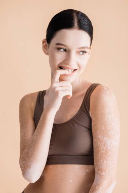 Vitiligo 'lu genç ve güzel bir kadın bej rengi iç çamaşırlarıyla poz veriyor.