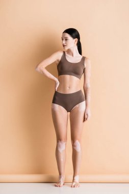 Vitiligo 'su olan genç ve güzel bir kadın bej rengi iç çamaşırlarıyla poz veriyor.