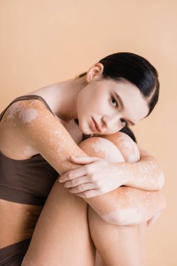 Vitiligo 'su olan genç ve güzel bir kadın bej rengi üzerinde izole edilmiş.