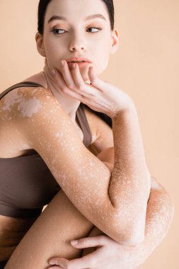 Vitiligo 'su olan genç ve güzel bir kadın bej rengi üzerinde izole edilmiş.
