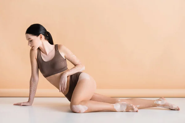 Jong Mooi Vrouw Met Vitiligo Poseren Vloer Beige Achtergrond — Stockfoto
