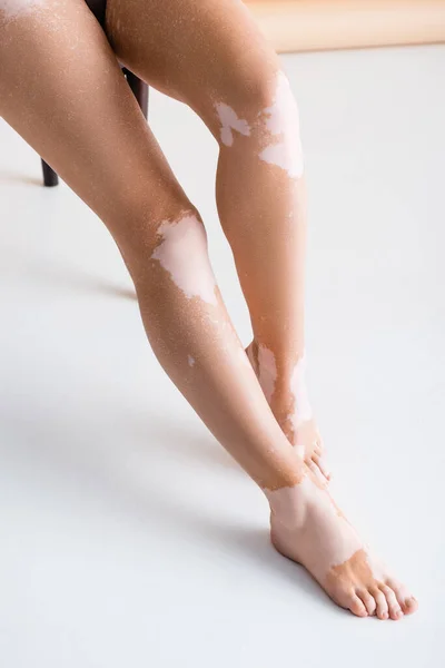 Beskärd Bild Kvinnliga Ben Med Vitiligo Vit Bakgrund — Stockfoto