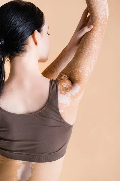 Terug Uitzicht Jonge Mooie Vrouw Met Vitiligo Poseren Geïsoleerd Beige — Stockfoto