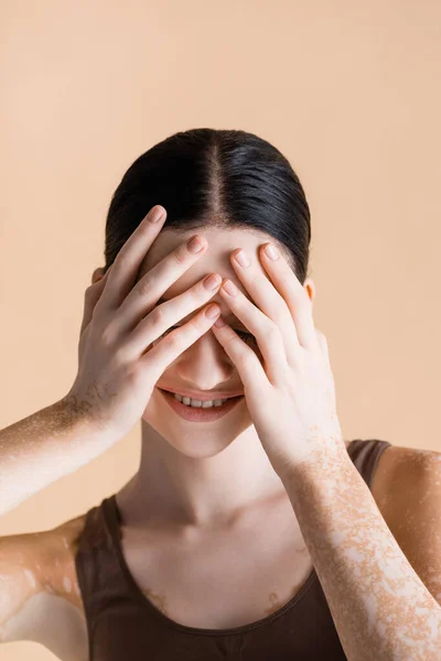 Sorrindo Jovem Bela Mulher Com Vitiligo Cobrindo Olhos Isolados Bege — Fotografia de Stock