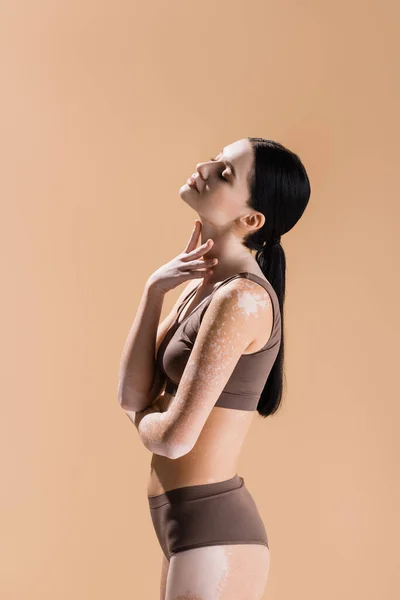 Vista Lateral Jovem Mulher Bonita Com Vitiligo Posando Isolado Bege — Fotografia de Stock