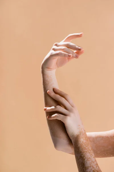 Beskuren Bild Kvinnliga Händer Med Vitiligo Isolerad Beige — Stockfoto