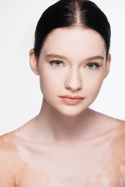 Retrato Joven Hermosa Mujer Con Vitiligo Aislado Blanco — Foto de Stock