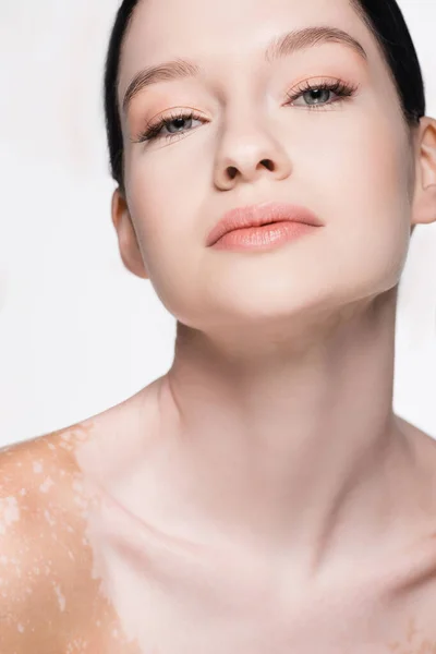 Portrait Young Beautiful Woman Vitiligo Isolated White — Stock Photo, Image