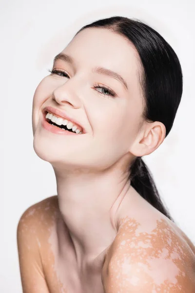 Smiling Young Beautiful Woman Vitiligo Isolated White — Stock Photo, Image