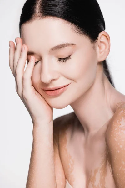Sorrindo Jovem Bela Mulher Com Vitiligo Isolado Branco — Fotografia de Stock