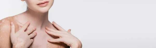 Beskåret Udsigt Ung Smuk Kvinde Med Vitiligo Isoleret Hvid Banner - Stock-foto