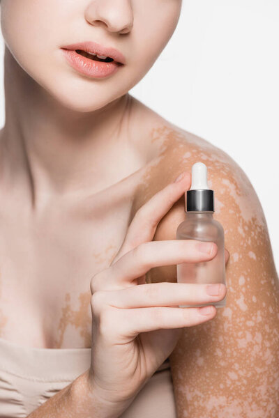cropped view of young beautiful woman with vitiligo holding serum isolated on white
