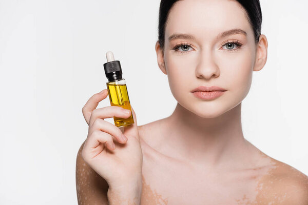 young beautiful woman with vitiligo holding essential oil isolated on white