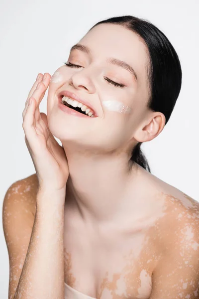 Sonriente Joven Hermosa Mujer Con Vitiligo Crema Facial Las Mejillas —  Fotos de Stock