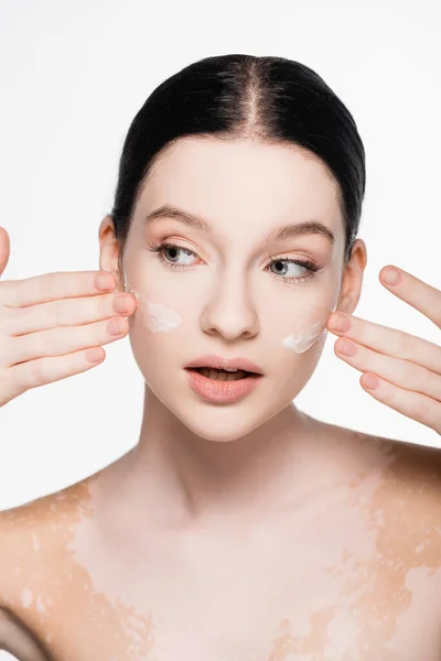 Smiling Young Beautiful Woman Vitiligo Facial Cream Cheeks Isolated White — Stock Photo, Image