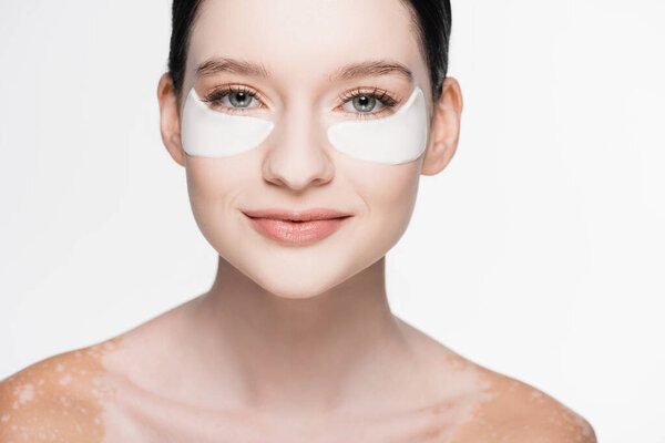 young beautiful woman with vitiligo and eye patches on face isolated on white