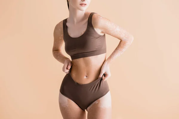 Cropped View Young Beautiful Woman Vitiligo Posing Underwear Isolated Beige — Stock Photo, Image