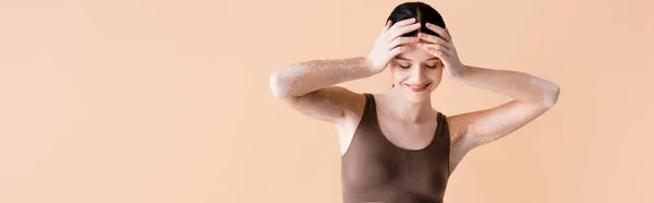 Smiling Young Beautiful Woman Vitiligo Posing Underwear Isolated Beige Banner — Stock Photo, Image