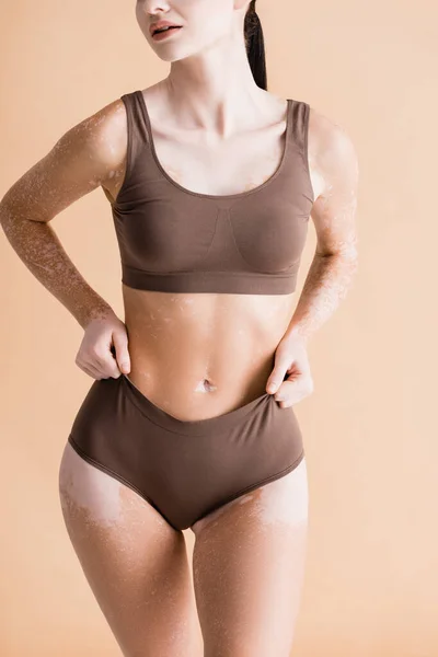 Beskuren Utsikt Över Ung Vacker Kvinna Med Vitiligo Poserar Underkläder — Stockfoto