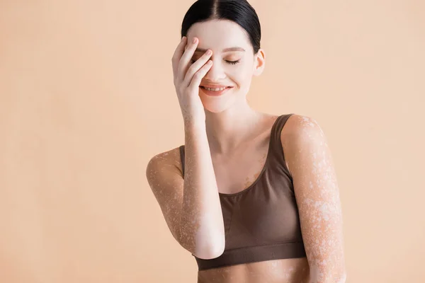 Leende Ung Vacker Kvinna Med Vitiligo Poserar Underkläder Isolerade Beige — Stockfoto