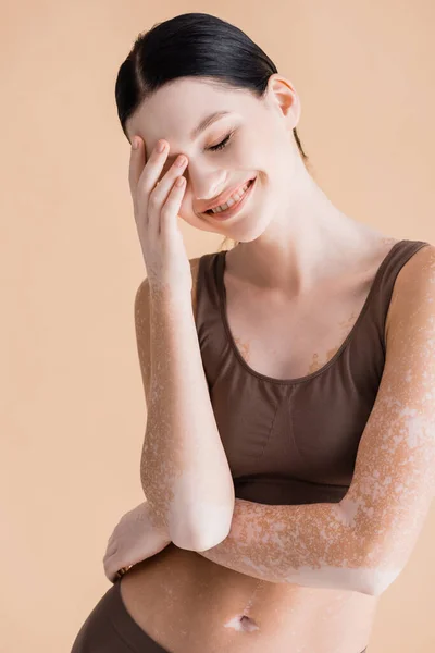 Leende Ung Vacker Kvinna Med Vitiligo Poserar Underkläder Isolerade Beige — Stockfoto