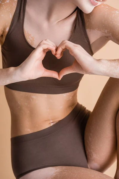 Beskuren Bild Kvinna Med Vitiligo Visar Hjärtat Med Händerna Isolerade — Stockfoto