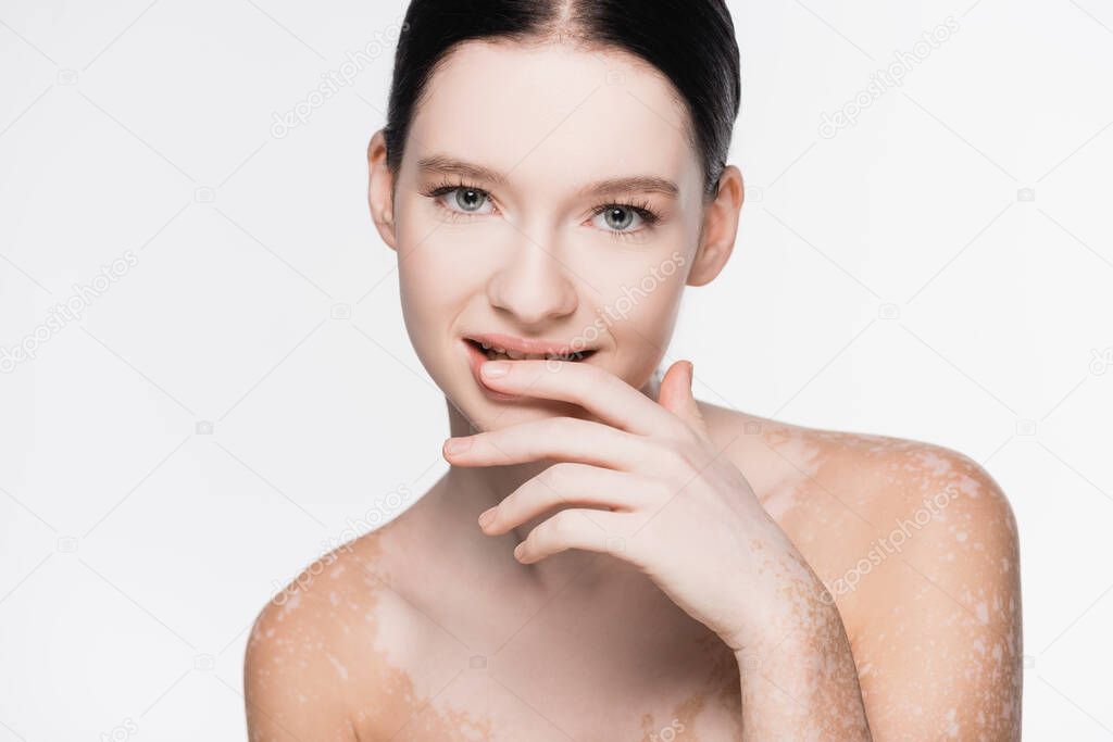 young beautiful woman with vitiligo isolated on white