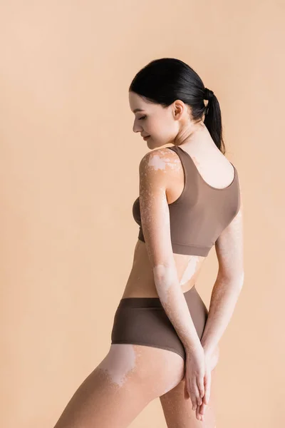 Young beautiful woman with vitiligo posing isolated on beige — Stock Photo