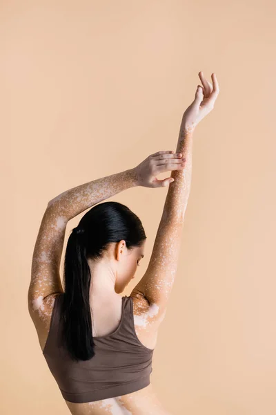 Back view of young beautiful woman with vitiligo posing isolated on beige — Stock Photo