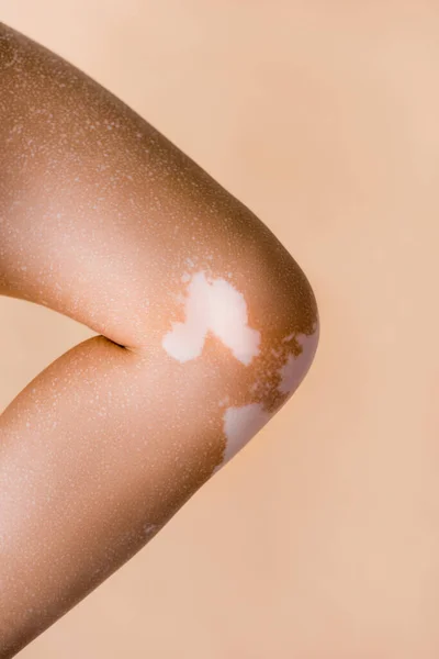 Vue recadrée de la jambe femelle avec vitiligo isolé sur beige — Photo de stock