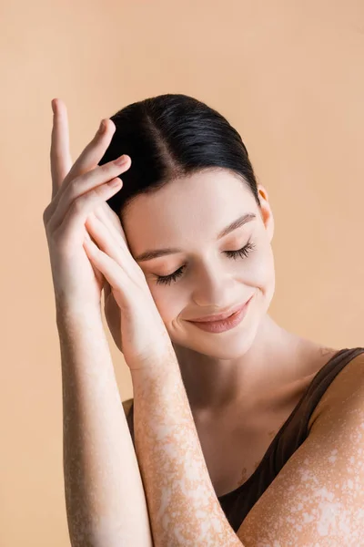 Sonriente joven hermosa mujer con vitiligo posando aislado en beige - foto de stock